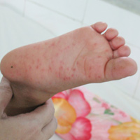 Tay chân miệng bùng phát thành dịch (ảnh minh họa)