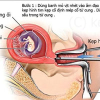 Hình ảnh mô phỏng nạo thai. (Ảnh minh họa)