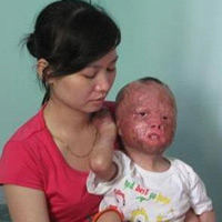 Khuôn mặt bé Linh biến dạng khi bị cha thiêu sống