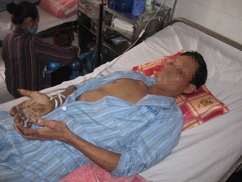giap tet canh giac voi benh lien cau lon - 1