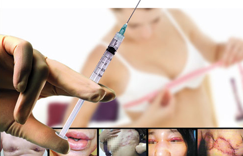 bien chung toan than vi tiem silicone - 1