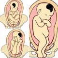 Bà bầu - 12 kiểu ngôi thai khiến bác sĩ ‘đau đầu’