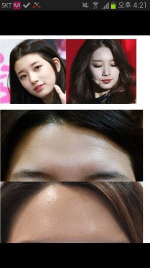suzy phau thuat tham my - 1