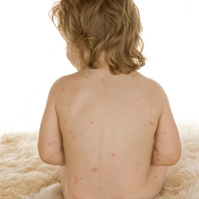 12 loại vacxin cần tiêm cho trẻ - 1