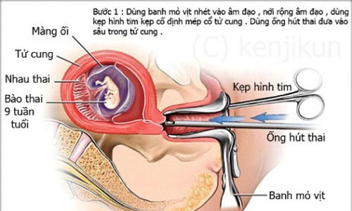 Các phương pháp bỏ thai an toàn - 1