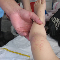 Biểu hiện, cách ngăn ngừa bệnh tay chân miệng