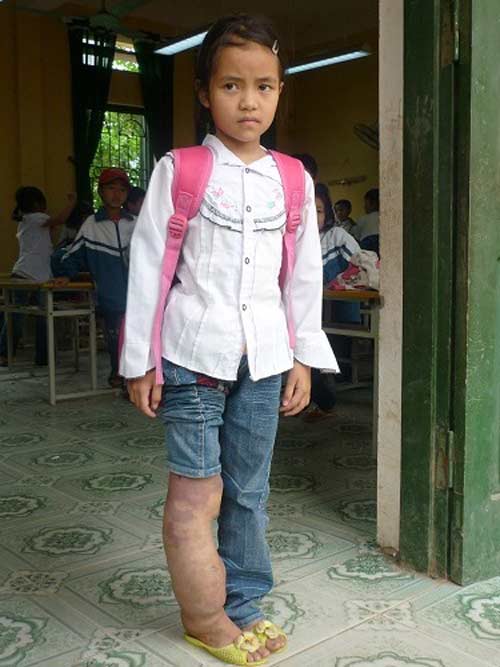 Đau xót: Bé gái khóc thét mỗi lần mặc quần - 4