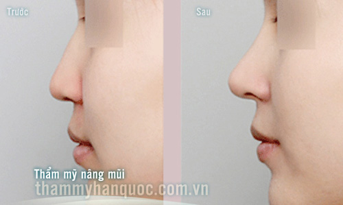 Phẫu thuật mũi ngắn bằng sụn vách ngăn - 2
