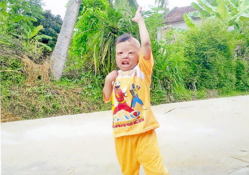 Nỗi đau còn lại của bé bị thiêu sống - 3