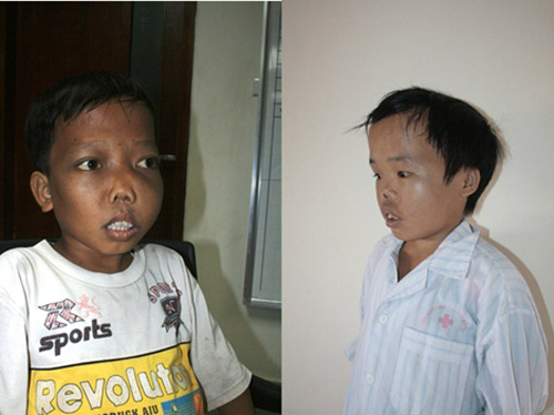 viet nam co khoang 5 trieu nguoi mac tan mau bam sinh - 1