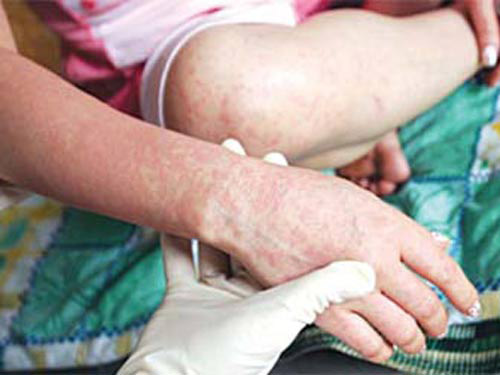 ba mom com, chau bi lay giang mai - 2