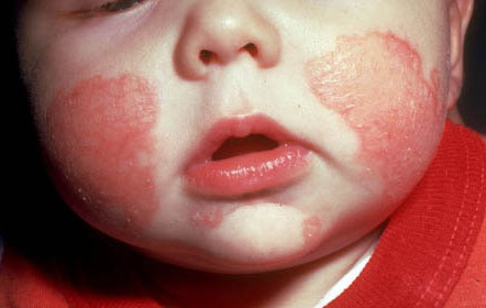 Chăm sóc da cho trẻ sơ sinh - 4 bệnh mẹ cần biết - 1