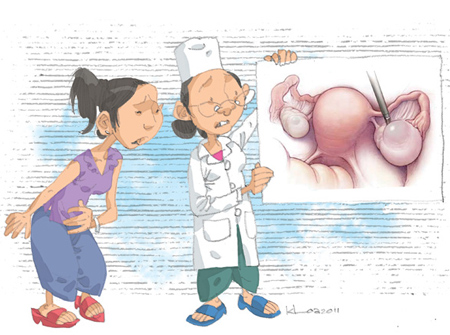 U nang buồng trứng để lâu thành ung thư - 1