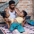 Tình yêu - Giới tính - Cặp dính liền cùng yêu một người đàn ông