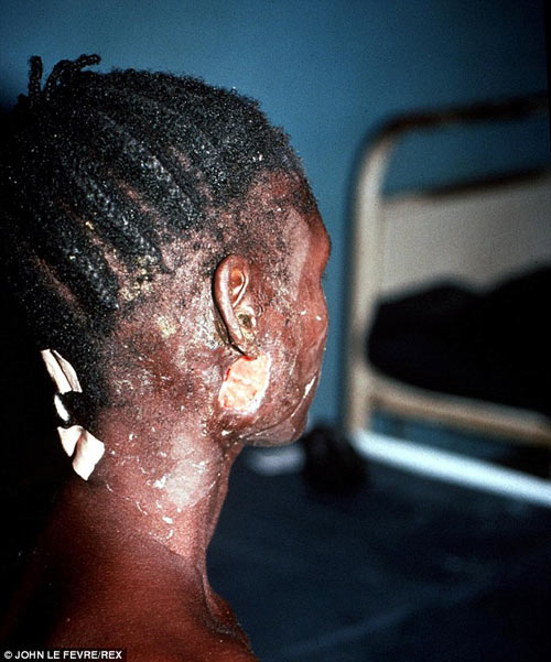 noi am anh khung khiep cua bac sy o tam dich ebola - 3