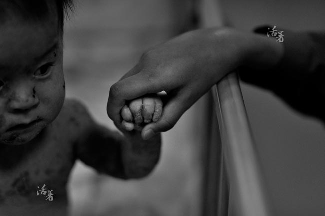 Xót xa em bé da bóng nước bị người thân bỏ rơi
