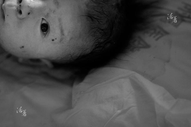 Xót xa em bé da bóng nước bị người thân bỏ rơi
