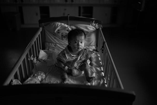 Xót xa em bé da bóng nước bị người thân bỏ rơi
