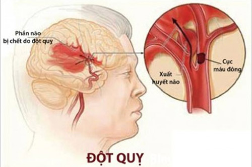 90% benh nhan dot quy bi di chung - 1