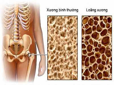 hieu dung de phong ngua benh xop xuong - 1