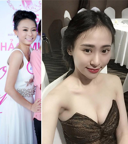 co gai 'lot xac' nho tiem chat lam day de mat thon, cam nhon - 1