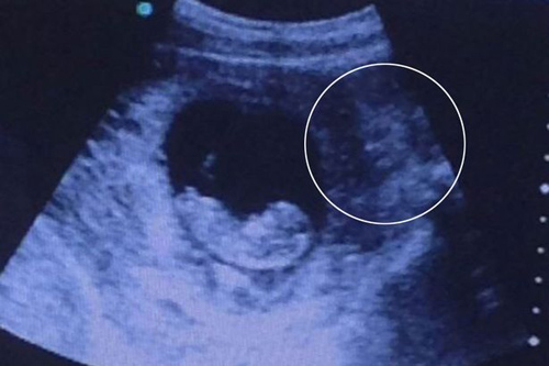 Hình ảnh siêu âm thai khiến người xem \