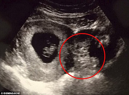 Hình ảnh siêu âm tử cung đôi: Nếu bạn đang trông chờ con cái, thì hãy xem ngay hình ảnh siêu âm tử cung đôi với khả năng thể hiện rõ nét cả hai đứa trẻ. Cùng khám phá sự ngộ nghĩnh của những thai nhi cùng phát triển trong bụng mẹ!