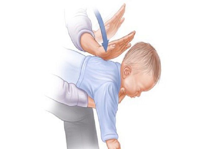 Tuyệt chiêu sơ cứu nhanh khi trẻ bị hóc, nghẹn