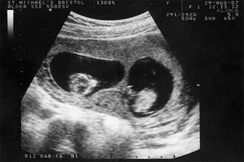 Nếu bạn đang mang thai đôi, bạn hãy xem hình ảnh siêu âm thai đôi của chúng tôi để cảm nhận sự đặc biệt, quý giá của sản phụ nhiều con. Hãy cùng chúng tôi chào đón hai thiên thần nhỏ đang phát triển trong bụng bạn!