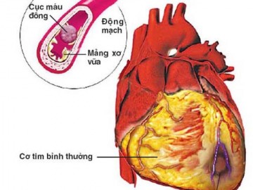 Cảnh giác đột quỵ não khi giao mùa