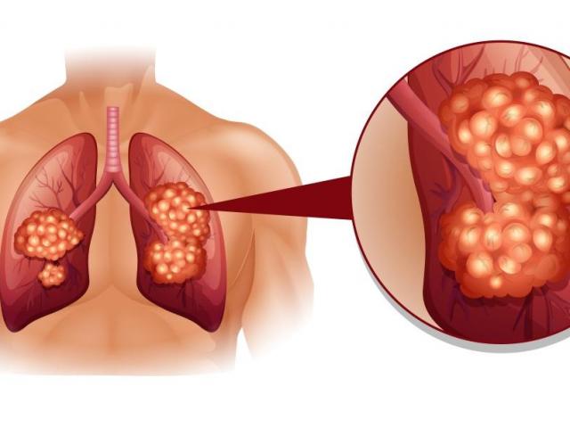 Dấu hiệu ung thư phổi bạn cần biết, ngay cả khi bạn không hút thuốc