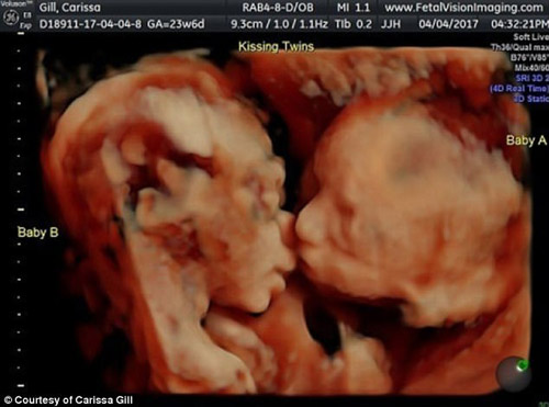 Không gì tuyệt vời hơn khi được theo dõi sự phát triển của hai em bé trong tử cung của mẹ. Hình ảnh siêu âm thai đôi khác trứng sẽ mang lại cho bạn niềm vui và cảm giác hạnh phúc kỳ diệu. Hãy xem nhé!