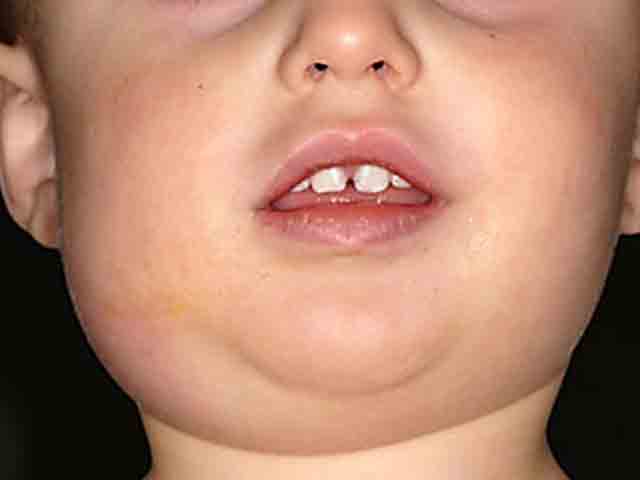 Triệu chứng bệnh quai bị ở trẻ em cha mẹ tuyệt đối không xem nhẹ