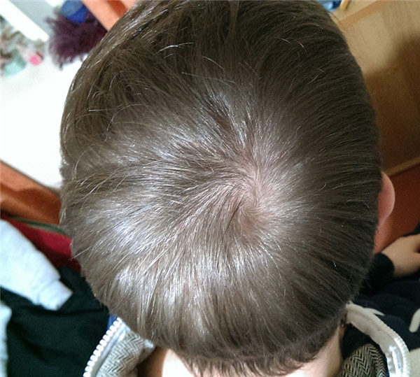 xoáy tóc trên đầu của đứa trẻ nói lên điều gì  Tin tức Online