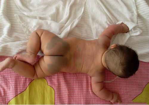 Lý giải sự thật đằng sau vết bớt xanh thường thấy trên mông trẻ sơ sinh - 1