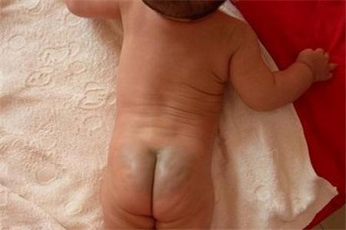 Lý giải sự thật đằng sau vết bớt xanh thường thấy trên mông trẻ sơ sinh