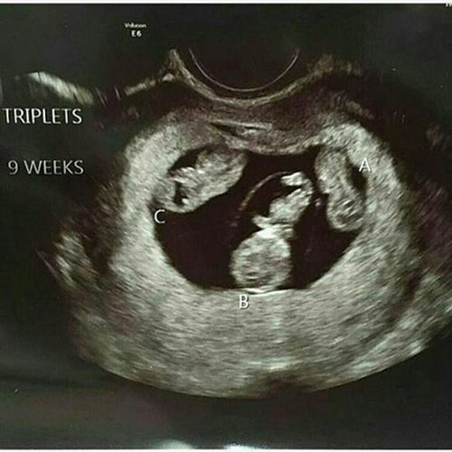 Siêu âm 3 thai: Hãy trải nghiệm siêu âm 3 thai để nhìn thấy 3 sinh linh bé nhỏ nhắn đang trưởng thành trong bụng mẹ. Bạn sẽ cảm thấy kì diệu và phấn khích khi chứng kiến chuyện phi thường này.