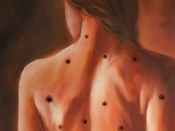 Nốt ruồi – dấu hiệu báo ung thư bạn cần biết