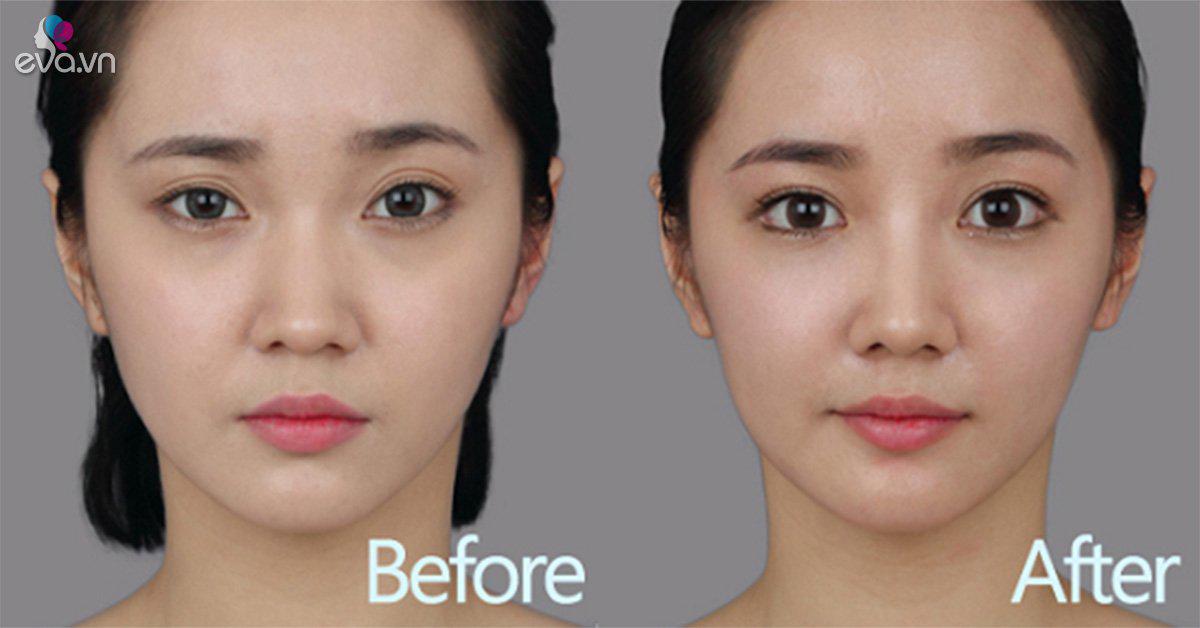 Отличие азиатов. Пластика разреза глаз. Изменение формы глаз. Операция по изменению формы глаз.