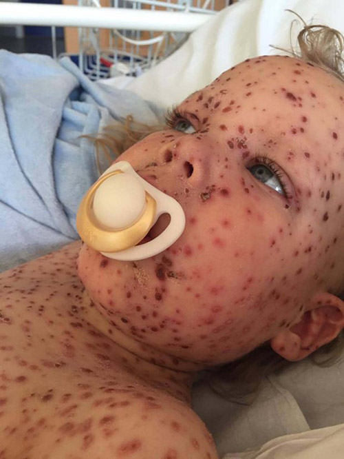 Căn bệnh đáng sợ mà em bé này mắc phải mọi trẻ em có thể tránh bằng một mũi tiêm