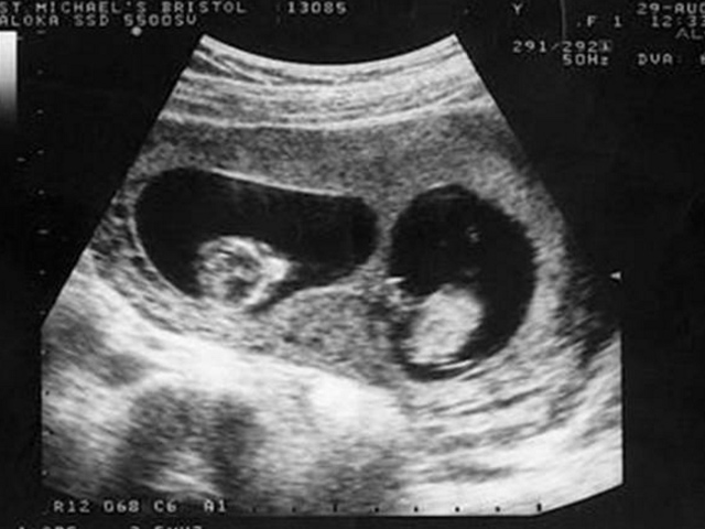 Siêu âm thai đôi: Hãy cùng xem hình ảnh siêu âm thai đôi đầy kỳ diệu này để khám phá thêm về việc mang thai đôi. Bạn sẽ bị choáng ngợp bởi sự tương đồng và khác biệt giữa hai sinh linh nhỏ bé này. Đây là một khoảnh khắc đáng nhớ trong cuộc đời của mỗi người mẹ và người cha.