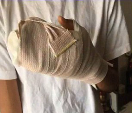Cậu bé 13 tuổi suýt mất tay chỉ vì vết cứa do mũ bảo hiểm
