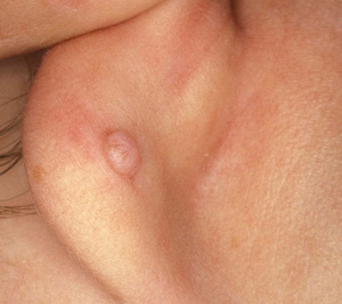 Ham bấm lỗ tai cho bé sơ sinh mẹ nhận hậu quả khó lường