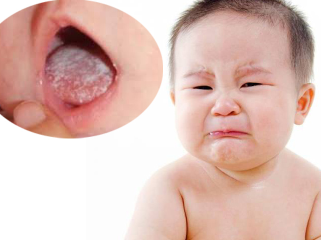 Kết quả hình ảnh cho Con bỠnấm lưỡi mẹ phải là m sao?
