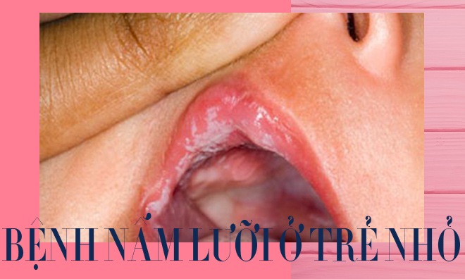Bệnh nấm lưỡi ở trẻ và nguyên nhân, cách phòng ngừa mẹ cần biết