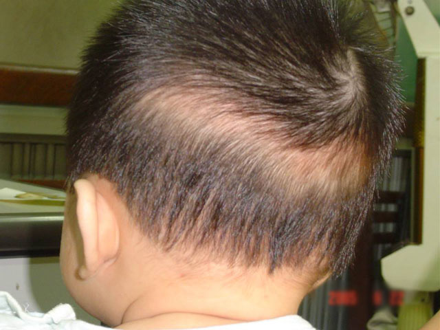Điều trị rụng tóc vành khăn ở trẻ sơ sinh không phải là điều quá khó khăn. Với một số cách đơn giản, bạn có thể giúp bé của mình hết vấn đề này. Nếu bạn đang còn đang lúng túng thì hãy xem hình ảnh liên quan để tìm hiểu các cách điều trị rụng tóc vành khăn này ngay nhé!