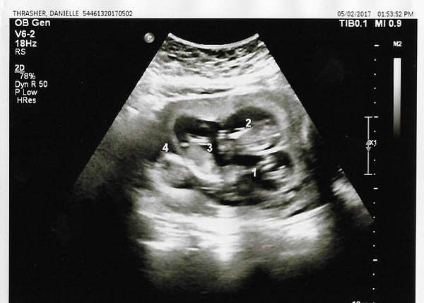 Hãy chiêm ngưỡng bức ảnh siêu âm thai đôi đẹp như tranh vẽ, chính xác từng đường cong và tính năng của từng em bé trong bụng mẹ. Hãy cảm nhận tình yêu hạnh phúc của gia đình bé nhỏ đang trưởng thành trong bụng mẹ.