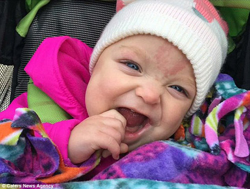 Nụ cười ngọt lịm của bé sơ sinh từng không thể ăn vì lưỡi to cứ cắt lại mọc