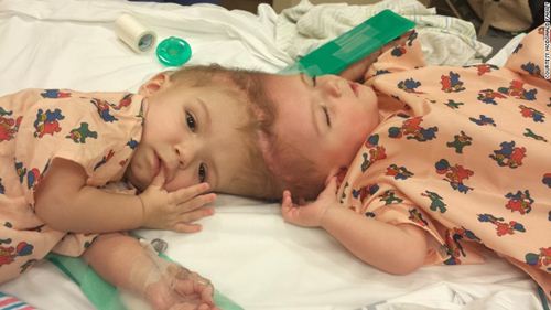 Hình ảnh khó tin của hai bé trai song sinh liền đầu sau phẫu thuật