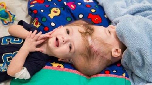 Hình ảnh khó tin của hai bé trai song sinh liền đầu sau phẫu thuật